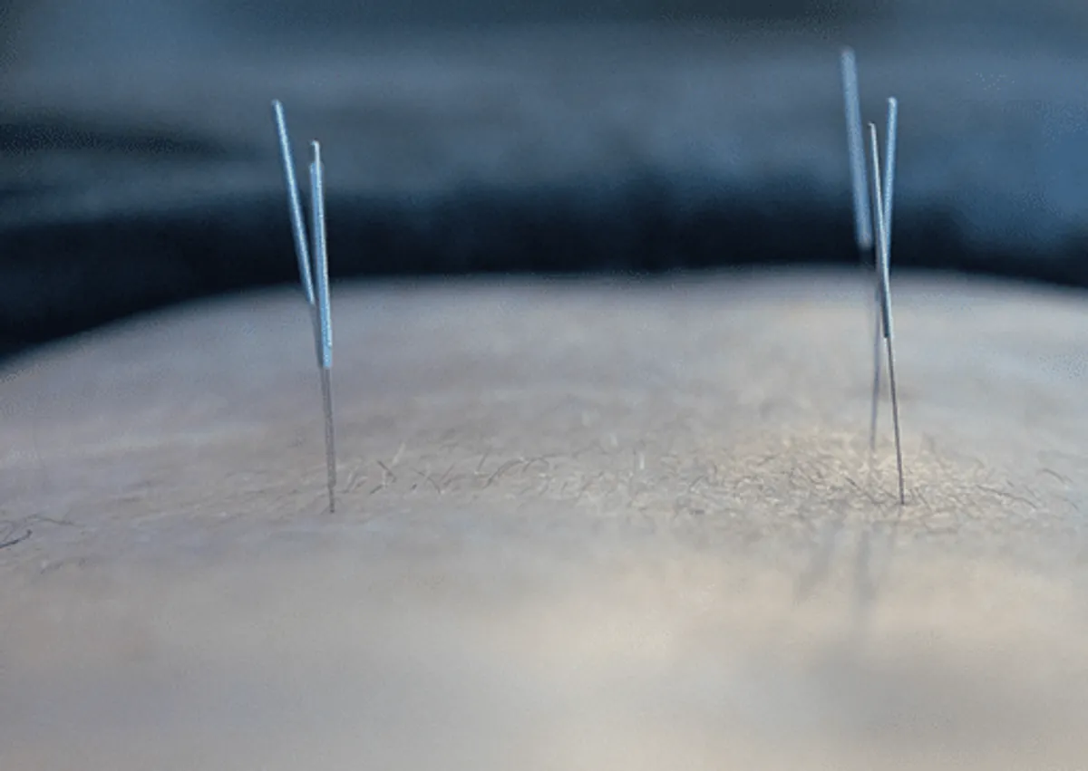 Sportsakupunktur nålebehandling i Lyngby