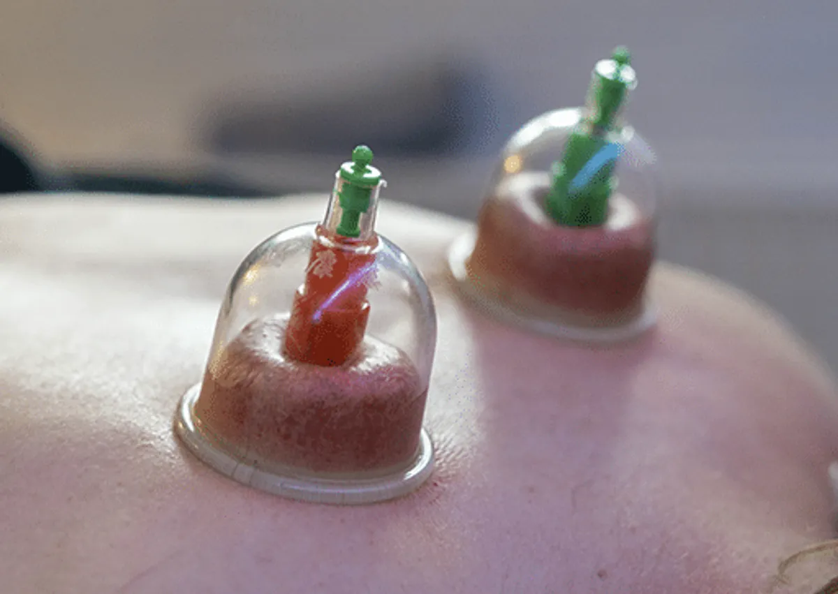 Cupping behandling hos iCare Massage i Lyngby