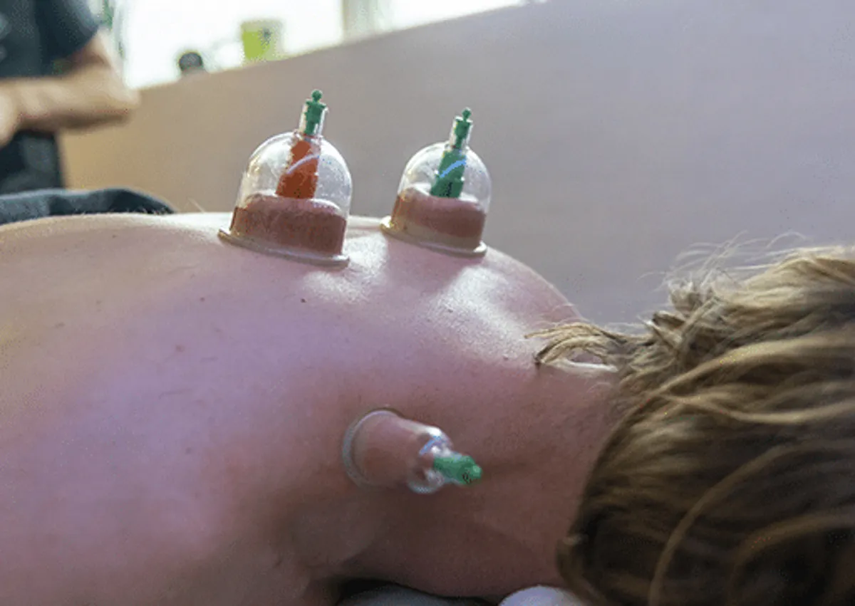 Cupping sugekopper på ryg